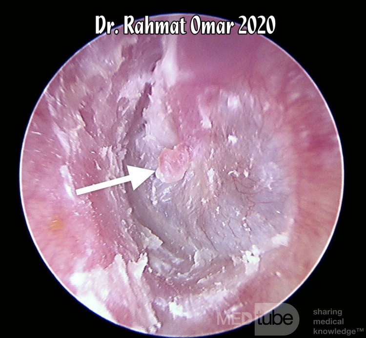Keratinosis of Ear Canal with Umbo Polyp
