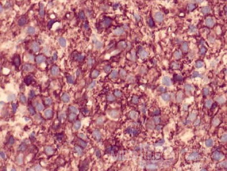 Gastrointestinal Stromal tumor (GIST) (63 of 65)