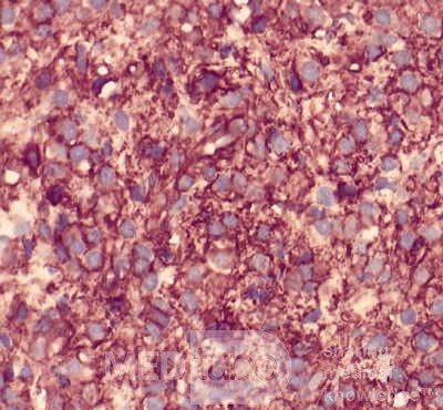 Gastrointestinal Stromal tumor (GIST) (63 of 65)