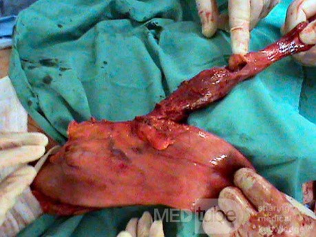 Barrett Adenocarcinoma - Endoscopic Image (13 of 20)