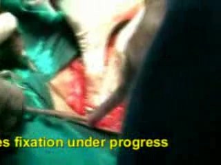 Surgical Treatment Of Pelvic Fractures