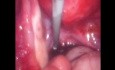 Endometrioma Cystectomy With the Help of Foley Catheter