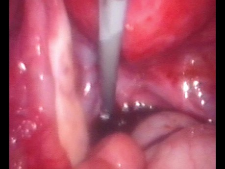 Endometrioma Cystectomy With the Help of Foley Catheter