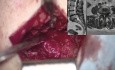 Microsurgical Management of L4–L5 Canal Stenosis