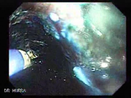 Barrett's Esophagus of long segment -Argon Plasma Coagulation (11 of 24)