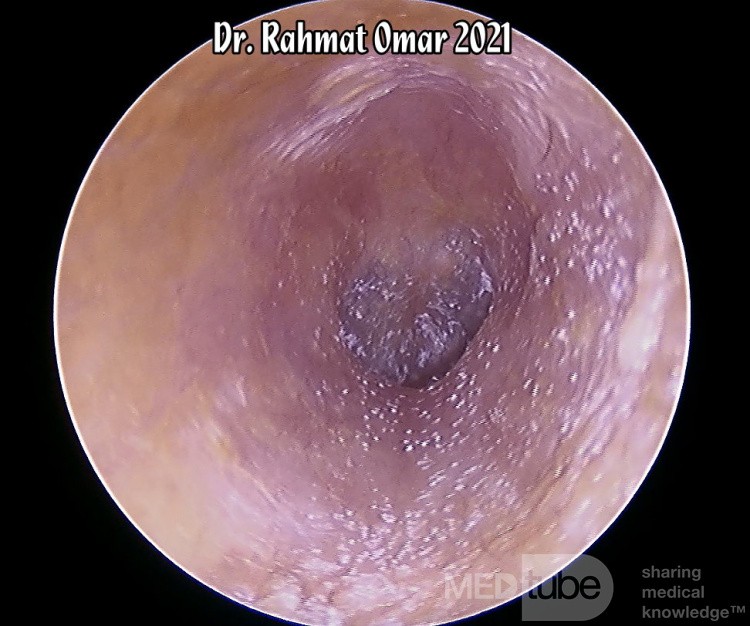 Steroid-Mixed Eardrop Dessicated Granules
