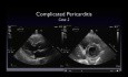 Complicated Pericarditis – Defining and Detecting the Abnormal Pericardium
