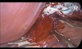 Laparoscopic Heller Myotomy and DOR Fundoplication Following Unsuccessful Balloon Dilation