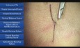 Instrument Tie - Suture Techniques