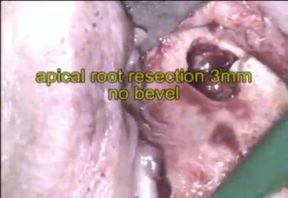 Endodontic surgery under the microscope