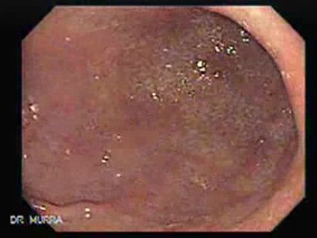 Ovarian Carcinoma with Gastric and Duodenal Metastases - 50 Years-Old Woman