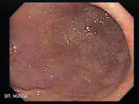 Ovarian Carcinoma with Gastric and Duodenal Metastases - 50 Years-Old Woman