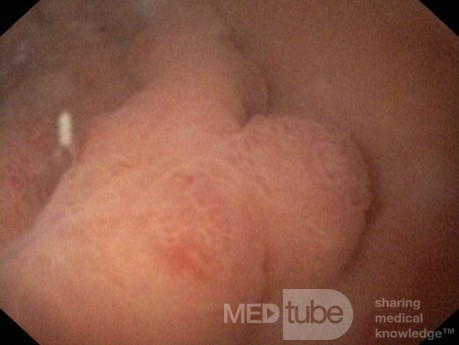 Unusual Appearance of Fundic Polyps. Chromoendoscopy. NET (3/6)
