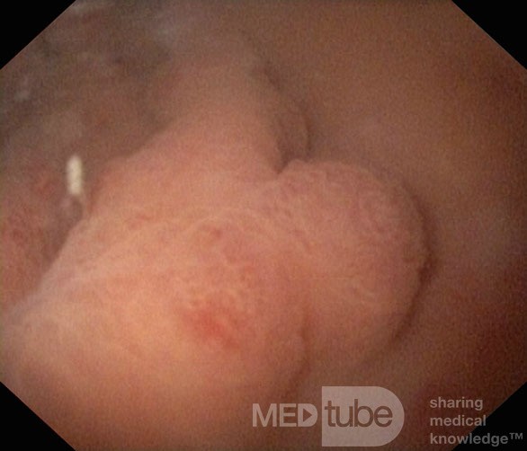 Unusual Appearance of Fundic Polyps. Chromoendoscopy. NET (3/6)
