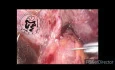 Laparoscopic CBD Exploration and Anastomosis After Failed ERCP