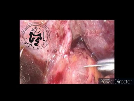 Laparoscopic CBD Exploration and Anastomosis After Failed ERCP