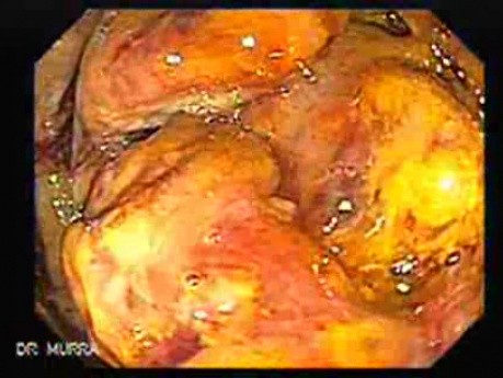 Toxic Dilatation Of The Colon Superimposed Pseudomembranous Colitis (5 z 17)