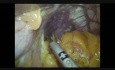 Three Trocars Laparoscopic Sleeve Gastrectomy