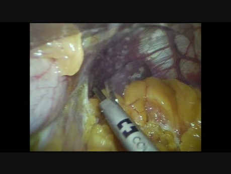 Three Trocars Laparoscopic Sleeve Gastrectomy