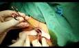 Hemorrhoid