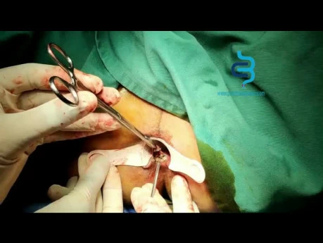 Hemorrhoid