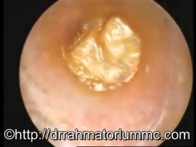 Foreign Body In The Ear Passage