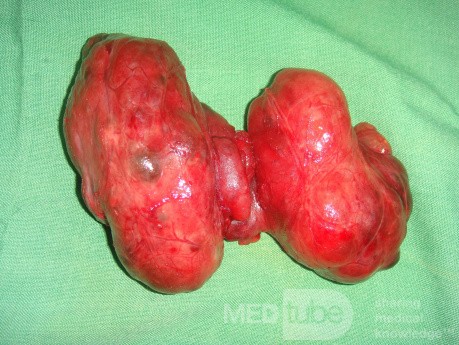 Toxic Goiter- total thyriodectomy