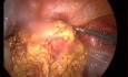 Ectopic Pregnancy, Surgical Treatment