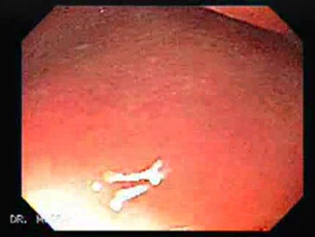 Adenocarcinoma of the Corpus and Antrum (2 of 5)