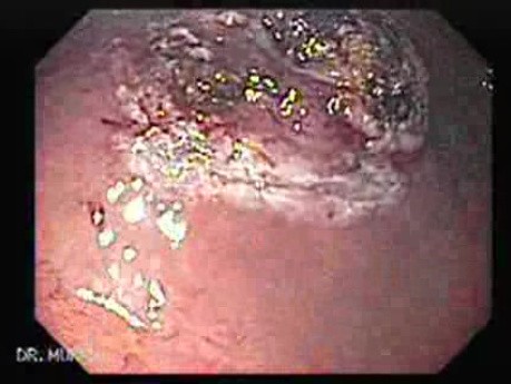 Gastrointestinal Stromal Tumor - GIST (9 of 65)