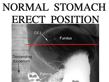 Surgical Radiology of Gastroduodenal Disorders