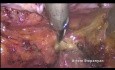 Laparoscopic Type C1 Radical Hysterectomy