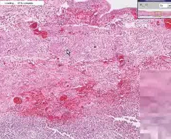 Colon - Hemorrhagic Infarhct