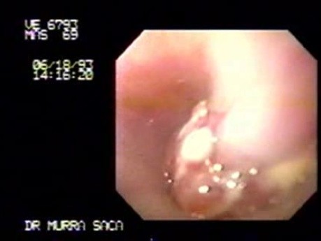 Adenocarcinoma of the Gastric Body