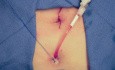 Suprapubic Catheter Placement At The Time Of Robotic Radical Prostatectomy