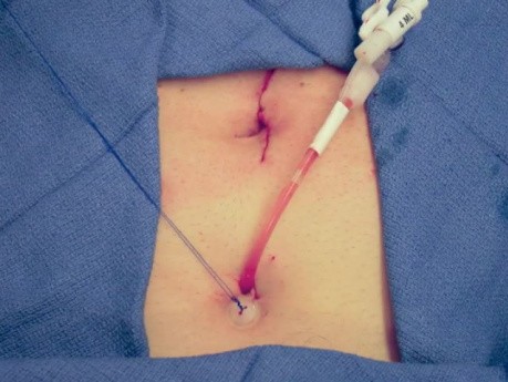 Suprapubic Catheter Placement At The Time Of Robotic Radical Prostatectomy
