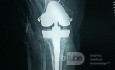 Post Operative Xray TKR with Augment