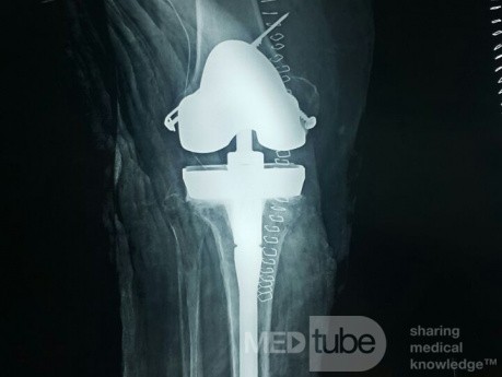 Post Operative Xray TKR with Augment