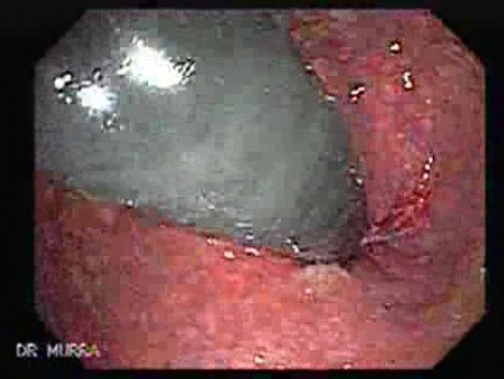 Status Post Rubber Band for Internal Hemorrhoids