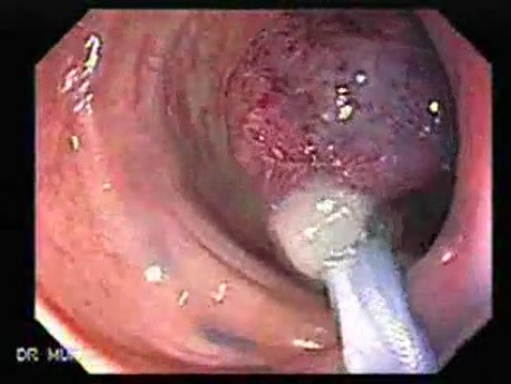 Colonoscopic Polypectomy (17 of 23)