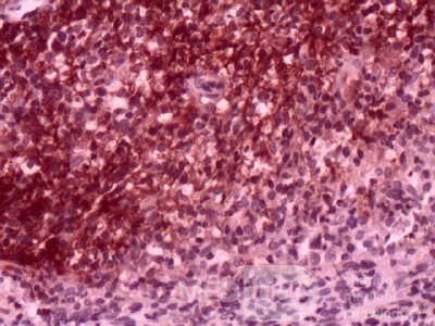 Gastric Lymphoma (10 of 10)
