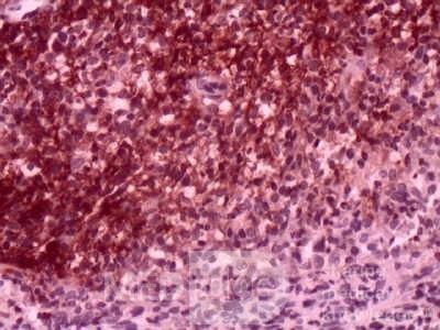 Gastric Lymphoma (10 of 10)