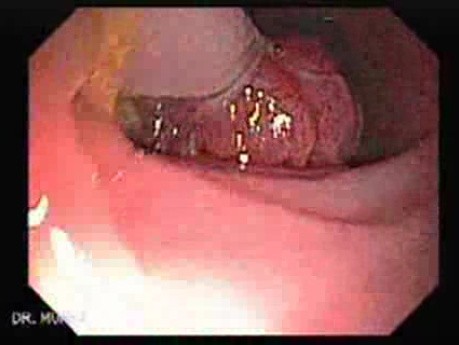Huge Mass Of The Descending Colon (3 of 25)