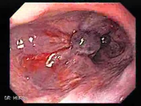 Long Standing Alcohol Abuse - Varices of the Fundus