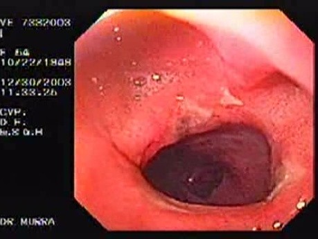 Multiple Ulcers of the Duodenal Bulb (2 of 2)