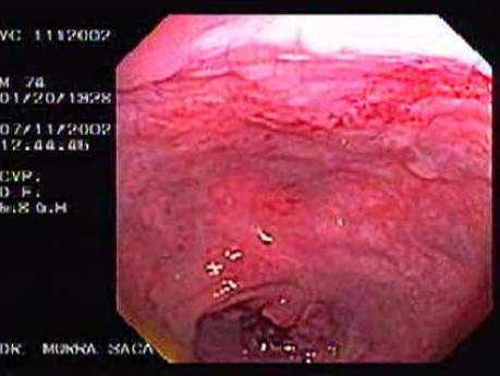 Rectal Adenocarcinoma Emerging From The First Valve (1 of 2)