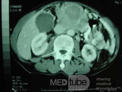 Gastric Ulcer with Gastrocolic fistula due to a Zollinger-
 Ellison Syndrome (32 of 33)