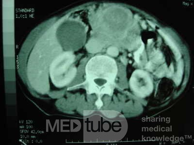 Gastric Ulcer with Gastrocolic fistula due to a Zollinger-
 Ellison Syndrome (32 of 33)