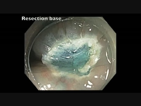 Subtle Flat Lesion EMR Base
