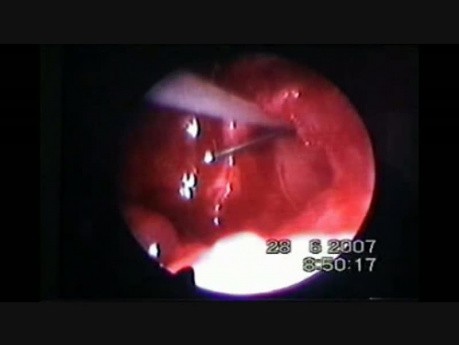 Pediatric Endoscopic DCR in Postsaccal Obstruction - Part 2